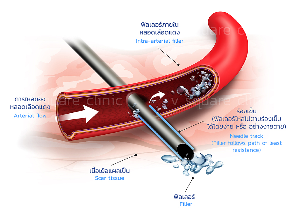 การฉีดฟิลเลอร์โดยใช้เข็มทู่ ถ้าใช้ขนาดเข็มเล็กเกินไปก็สามารถแทงเข้าเส้นเลือดได้