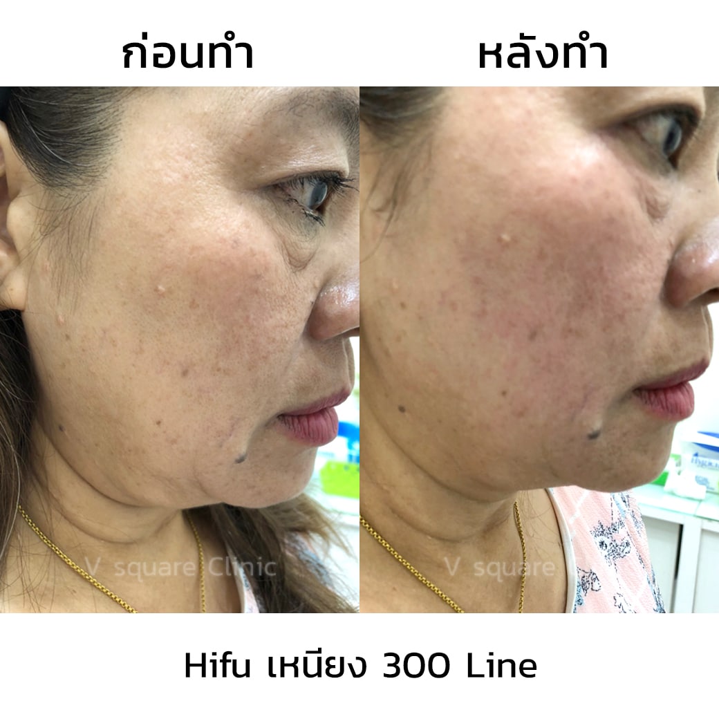 HF_เหนียง-300-Line