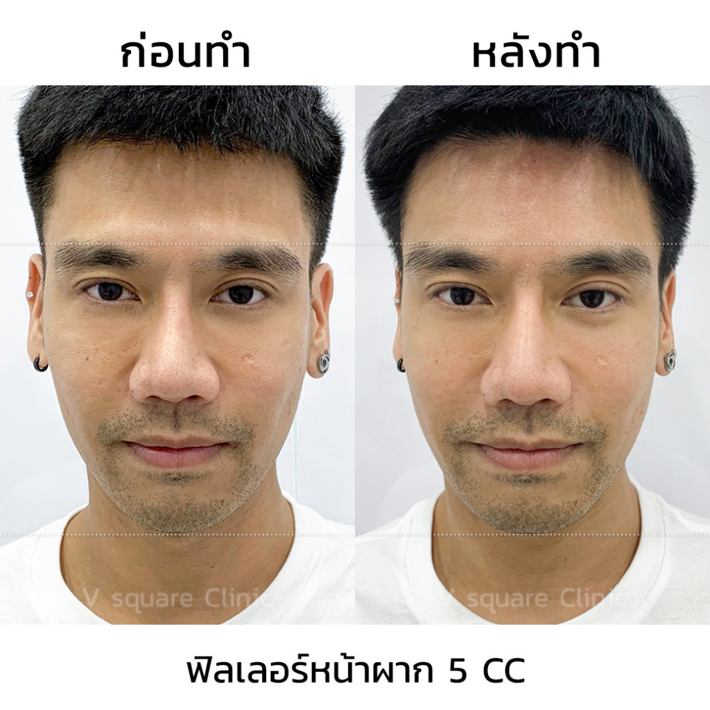 ฟิลเลอร์หน้าผาก5CC