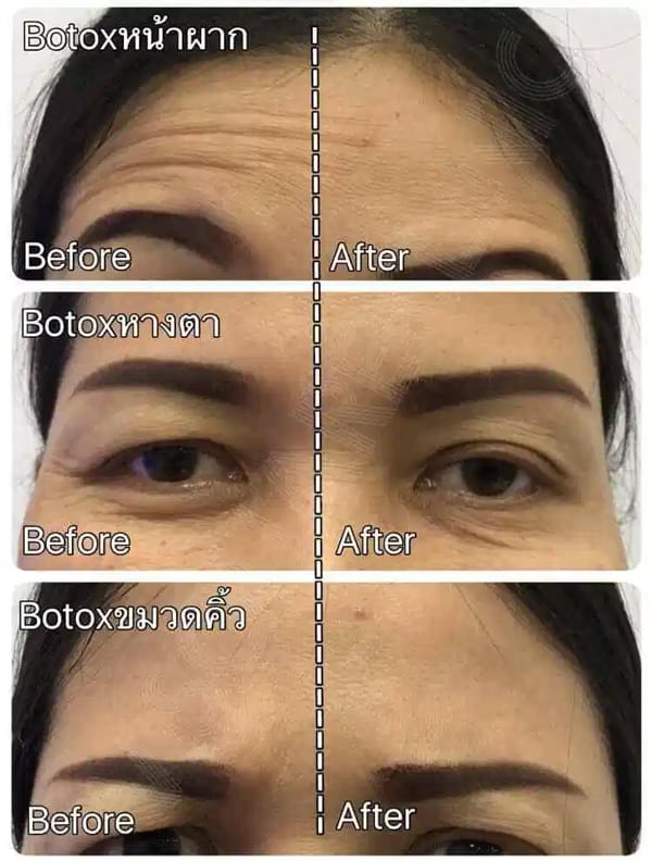 รีวิว ฉีดโบท็อกลดริ้วรอย