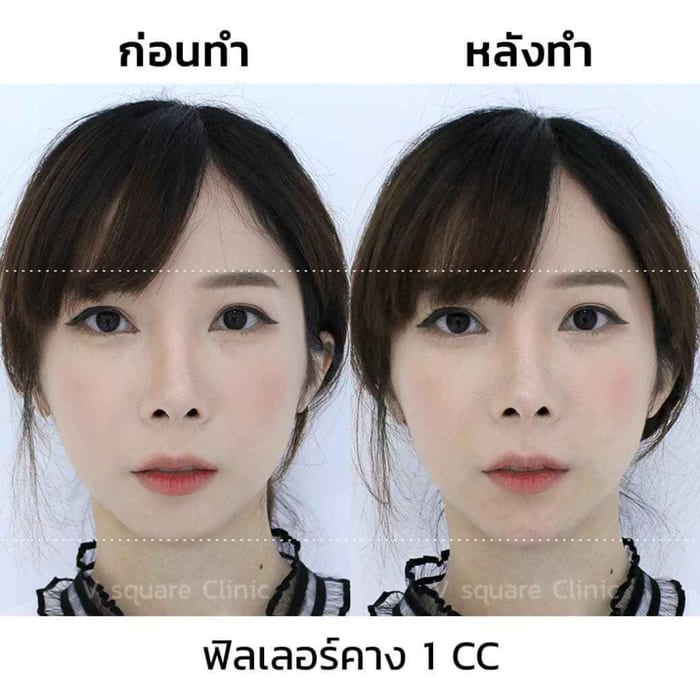 รีวิวฉีดฟิลเลอร์คาง