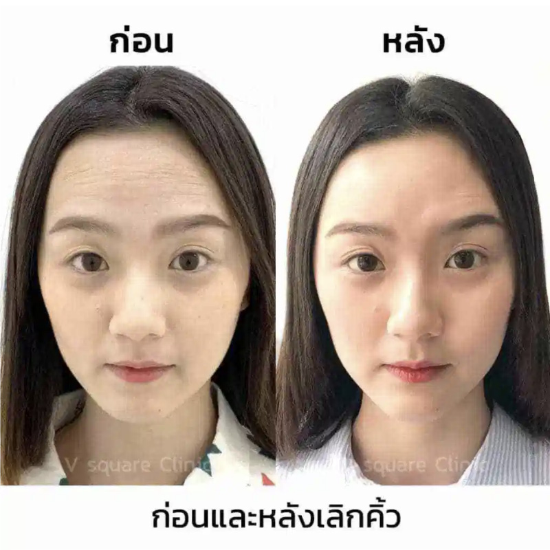 รีวิวฉีดโบท็อกลดริ้วรอยหน้าผาก