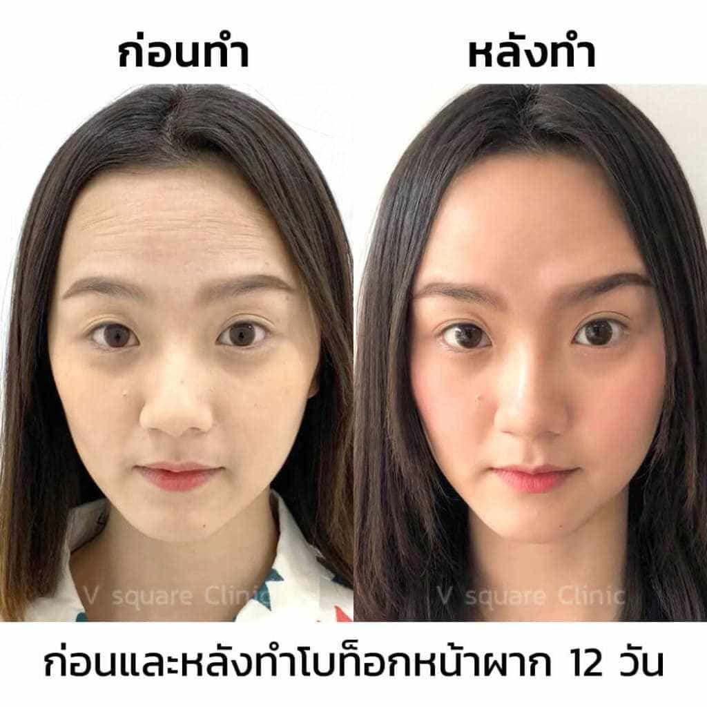 ฉีดโบท็อกหน้าผาก-กี่วันเห็นผล
