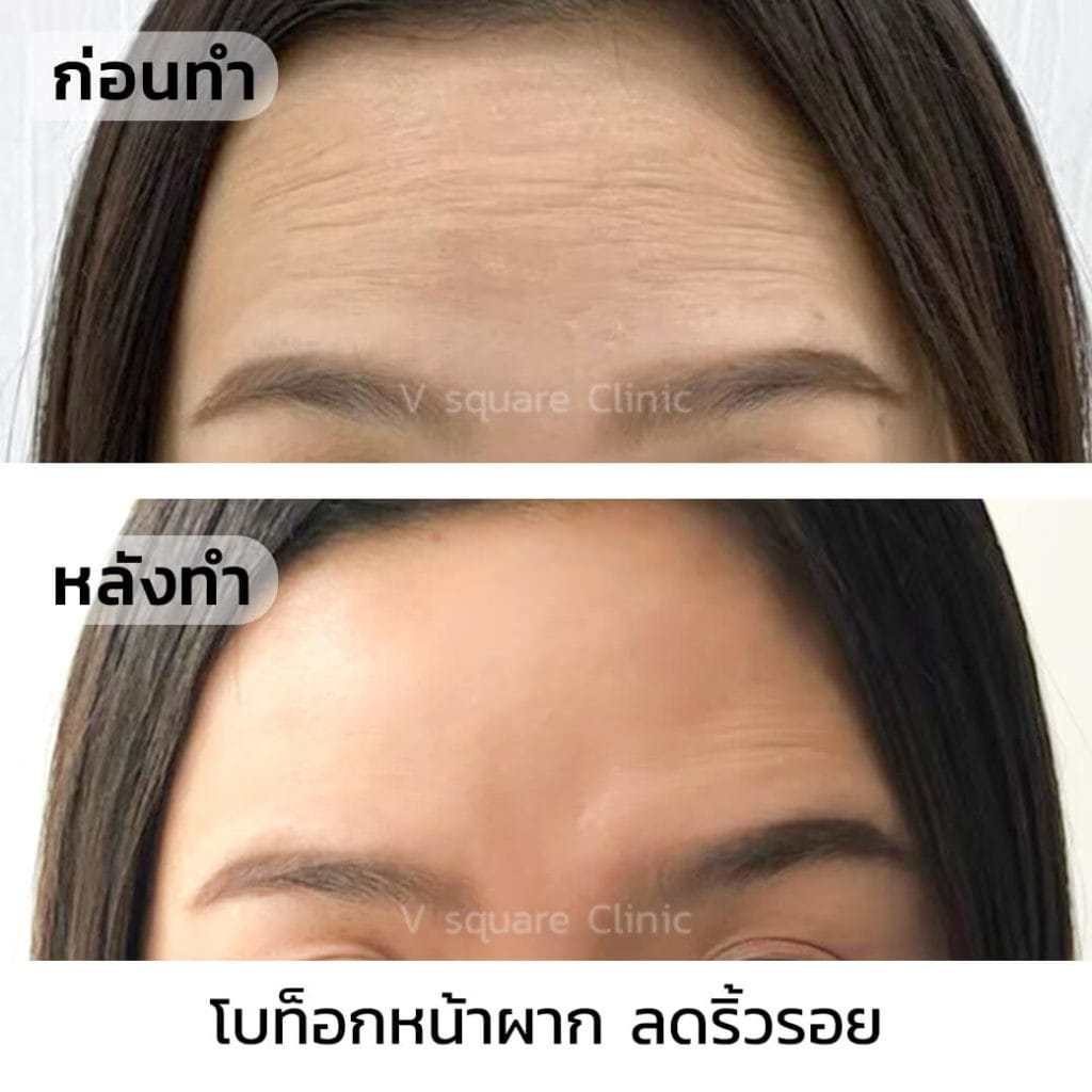 ฉีดโบท็อกหน้าผาก-ลดริ้วรอย