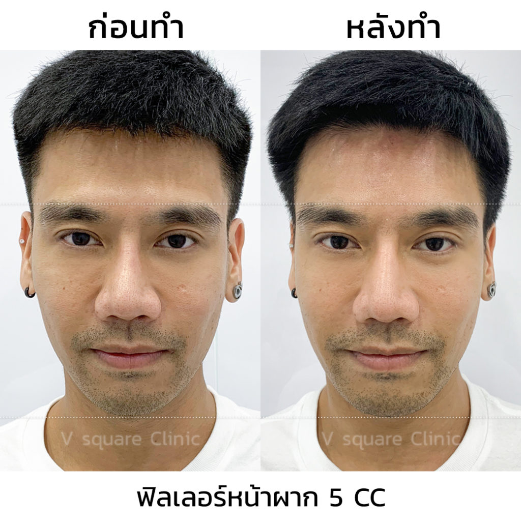 รีวิวฉีดฟิลเลอร์หน้าผาก-ด้านหน้า