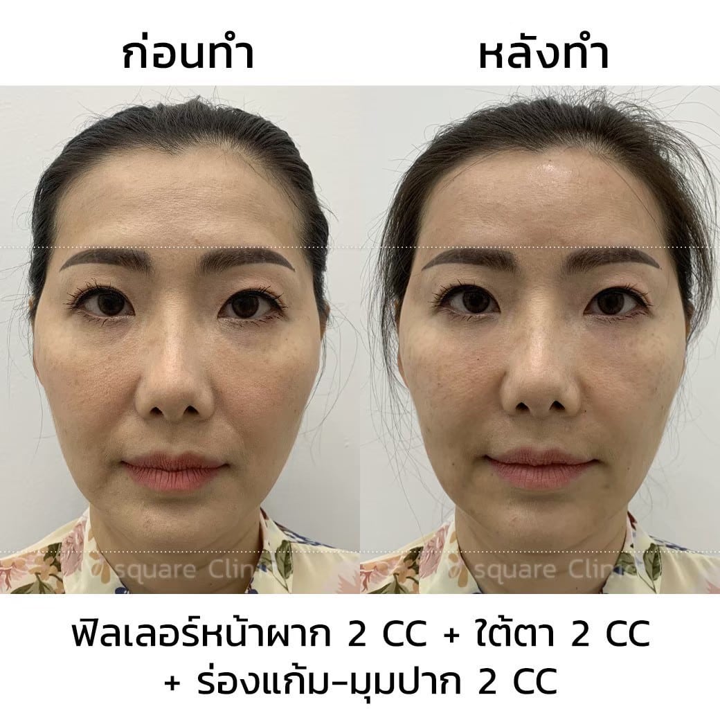 รีวิวฟิลเลอร์หน้าผากลดริ้วรอย