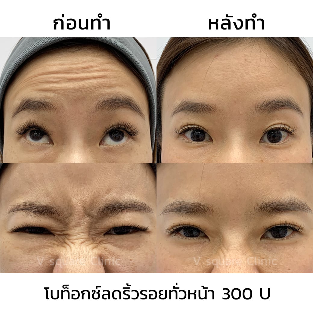 ลดริ้วรอยหน้าผากด้วยโบท็อก