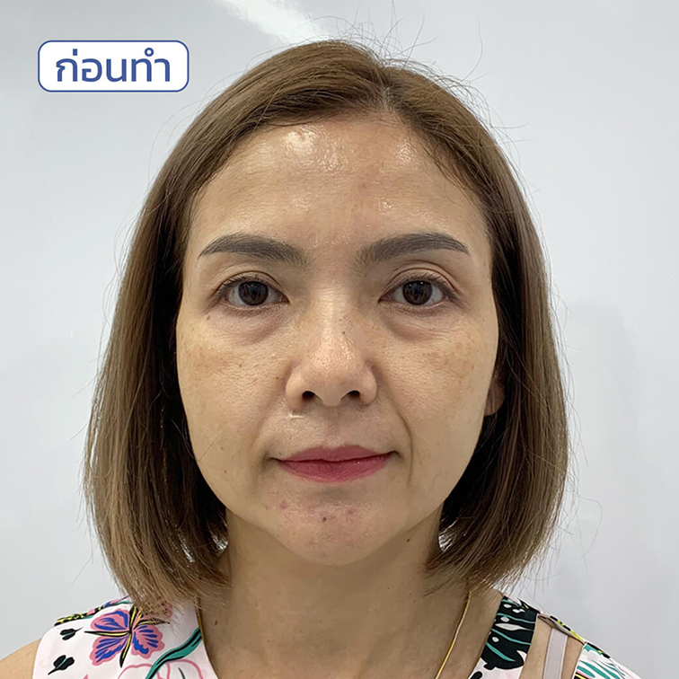 ก่อน-หลังเติมฟิลเลอร์ร่องแก้ม ก่อน-หลังเติมฟิลเลอร์ร่องแก้ม
