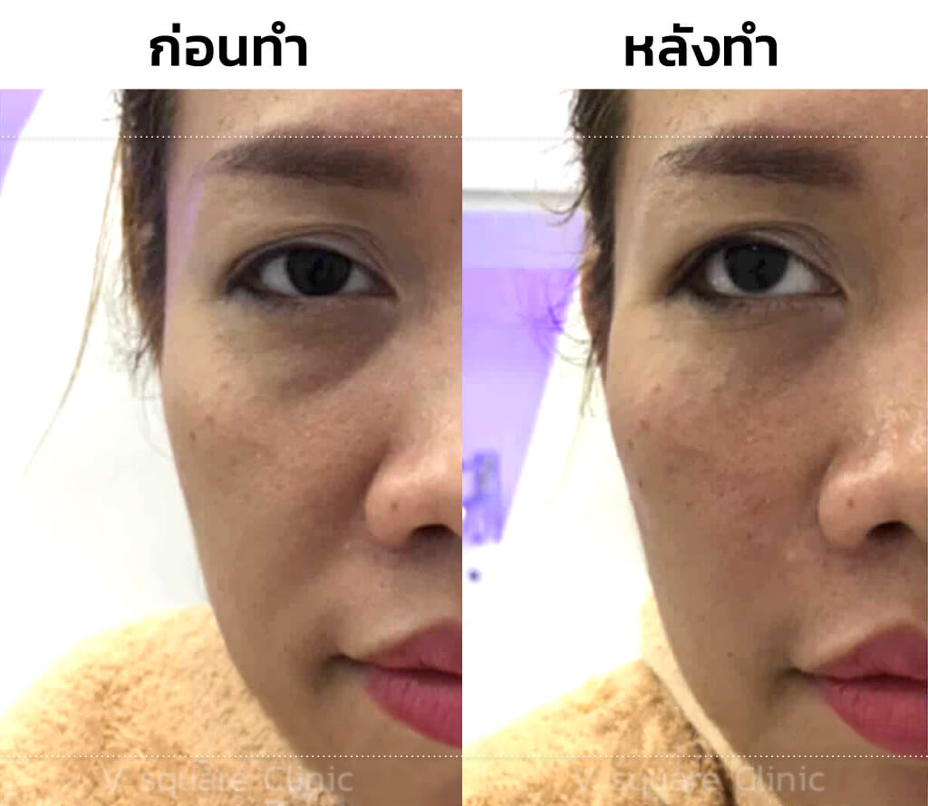 รีวิว แก้ไขร่องแก้มลึก-ฟิลเลอร์ร่องแก้ม