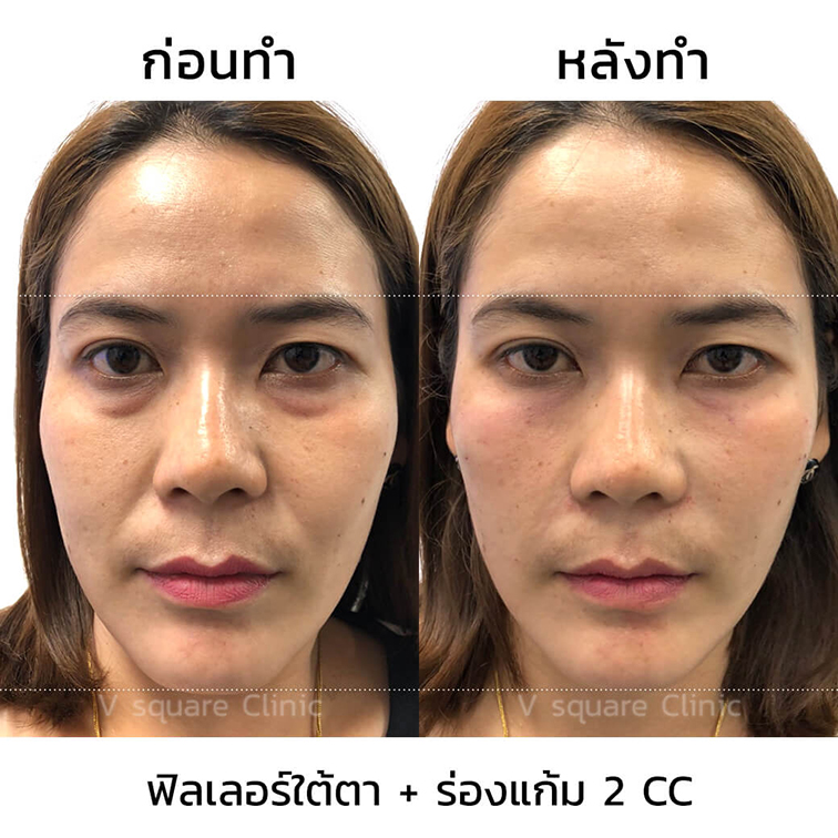 รีวิว-ฟิลเลอร์ร่องแก้ม-2-CC-ผู้หญิง