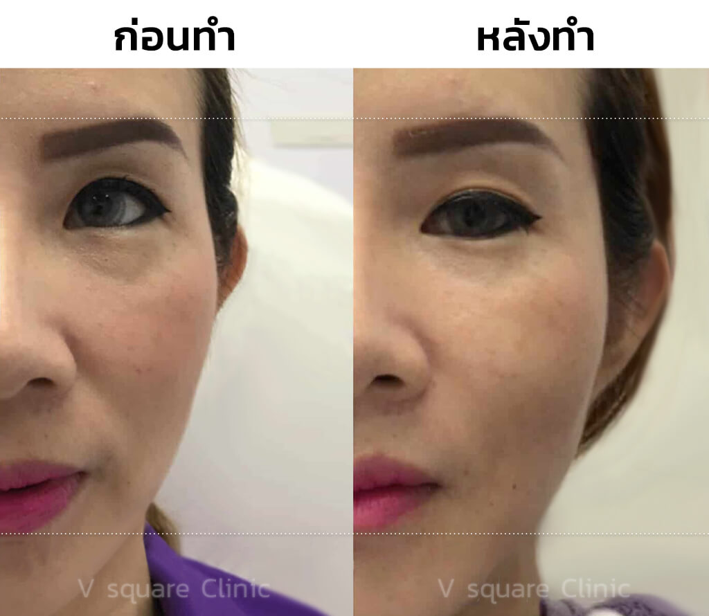 รีวิวแก้ไขร่องแก้มลึก-ฟิลเลอร์ร่องแก้ม-จุดเดียว