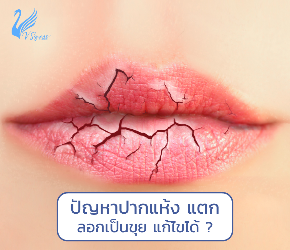 วิธีแก้ริมฝีปากแห้งมาก รักษาปากแตก เป็นร่อง ให้กลับมาชุ่มชื้นได้ง่าย ๆ วิธีแก้ริมฝีปากแห้งมาก รักษาปากแตก เป็นร่อง ให้กลับมาชุ่มชื้นได้ง่าย ๆ