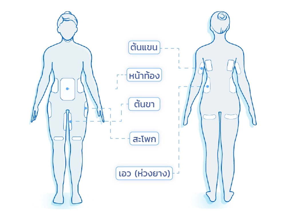 CoolSculpting ทำส่วนไหนได้บ้าง