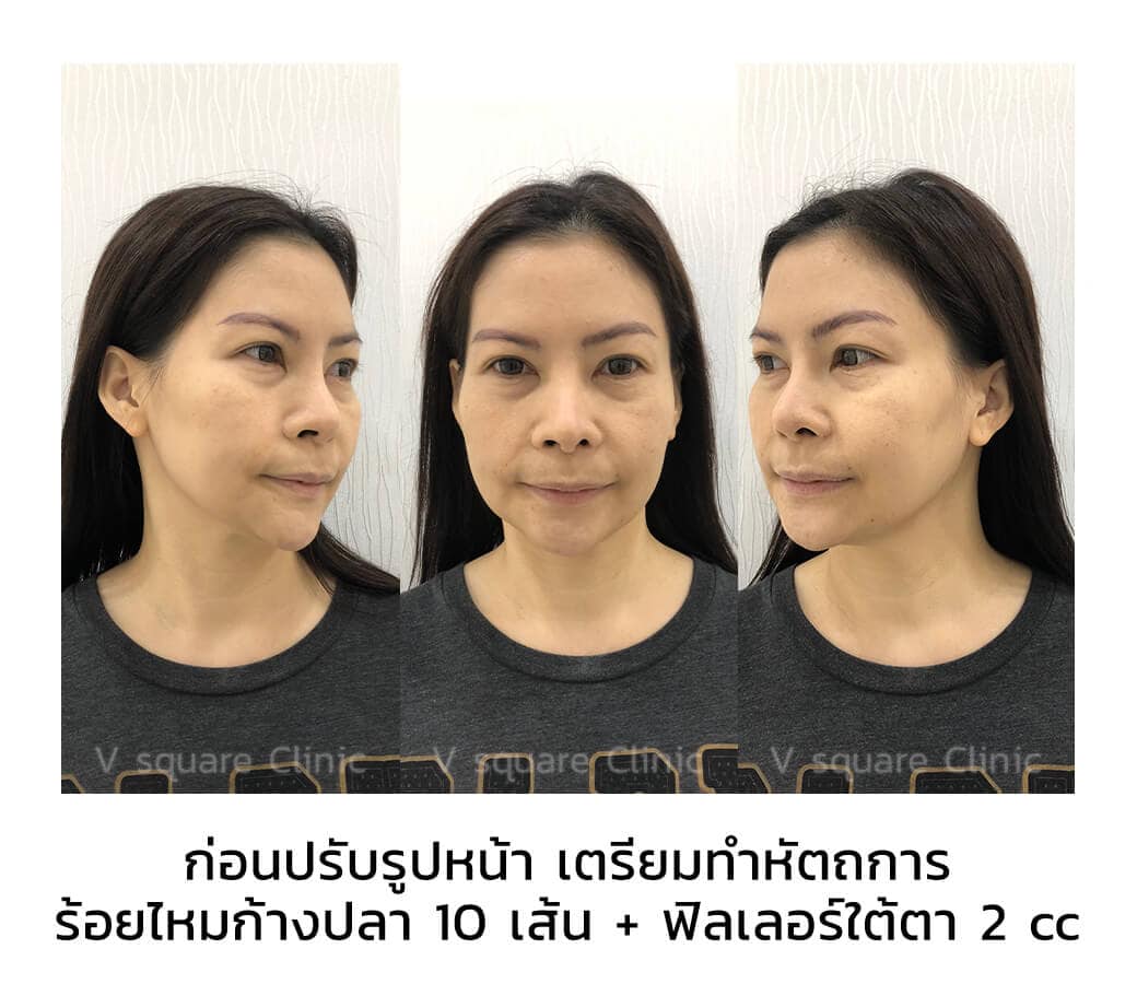 review_botox