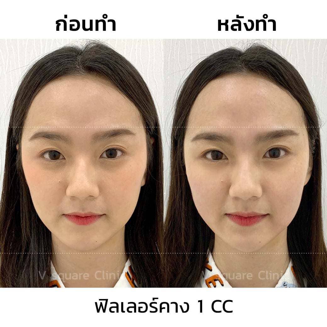 ฟิลเลอร์คาง1cc