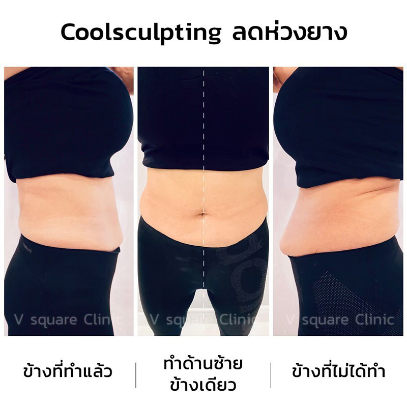 รีวิว-CoolSculpting-ลดห่วงยาง