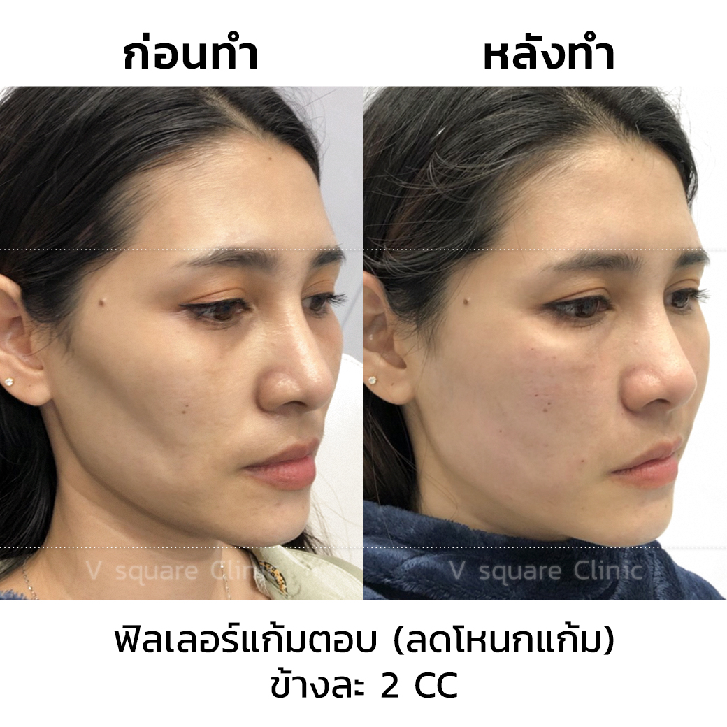 รีวิว-ฟิลเลอร์แก้มตอบ ข้างละ -2-CC