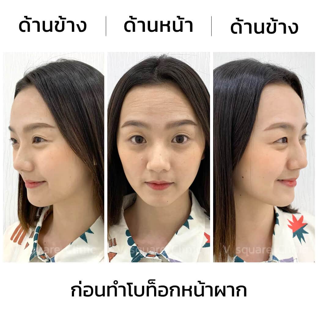 รีวิวก่อนทำโบท็อกหน้าผาก