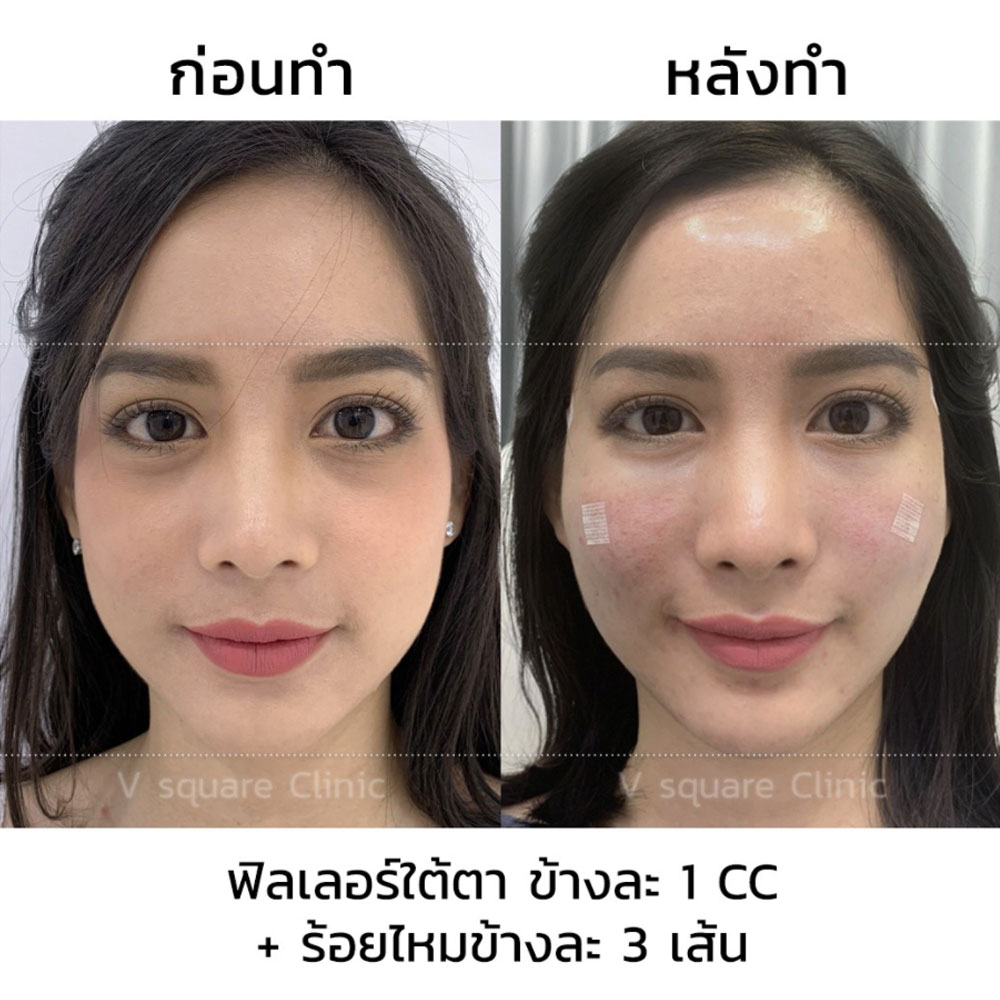 รีวิวฉีดฟิลเลอร์ใต้ตา