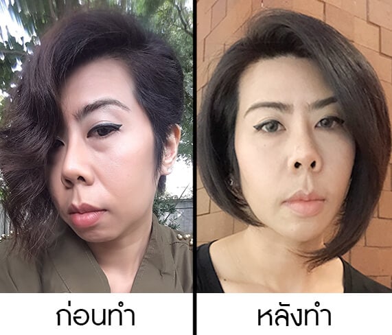 รีวิวทำฟิลเลอร์