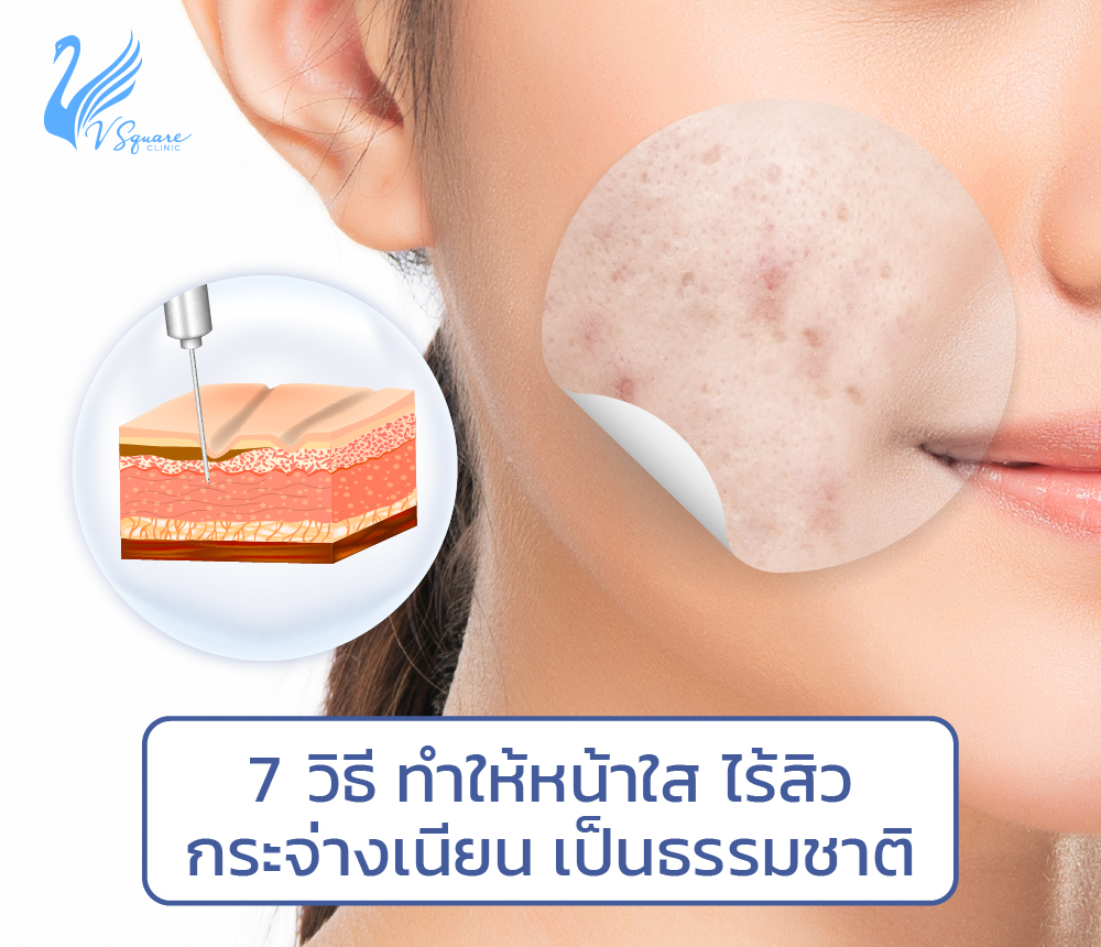 7-วิธีทําให้หน้าใส-ไร้สิว