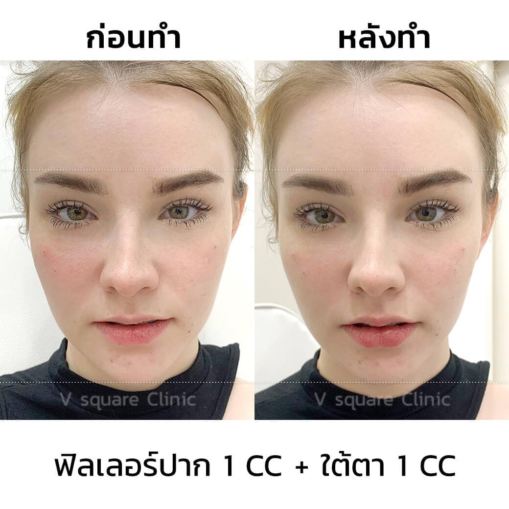 เจสซี่_ฟิลเลอร์ปาก1ccใต้ตา1