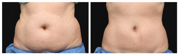 รีวิว-Coolsculpting-สลายไขมันหน้าท้อง