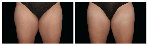 รีวิว-Coolsculpting-สลายไขมันต้นขา