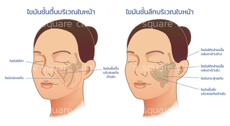 สลายไขมัน-ด้วยเมโสแฟต