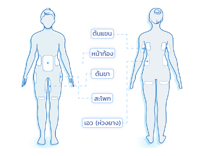 จุดสลายไขมัน-ด้วย-Coolsculpting