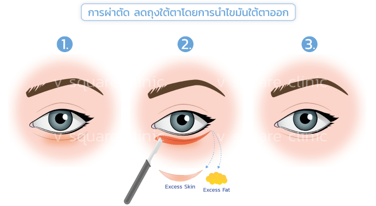 การผ่าตัด-ลดถุงใต้ตา