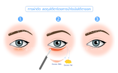 การผ่าตัด-ลดถุงใต้ตา