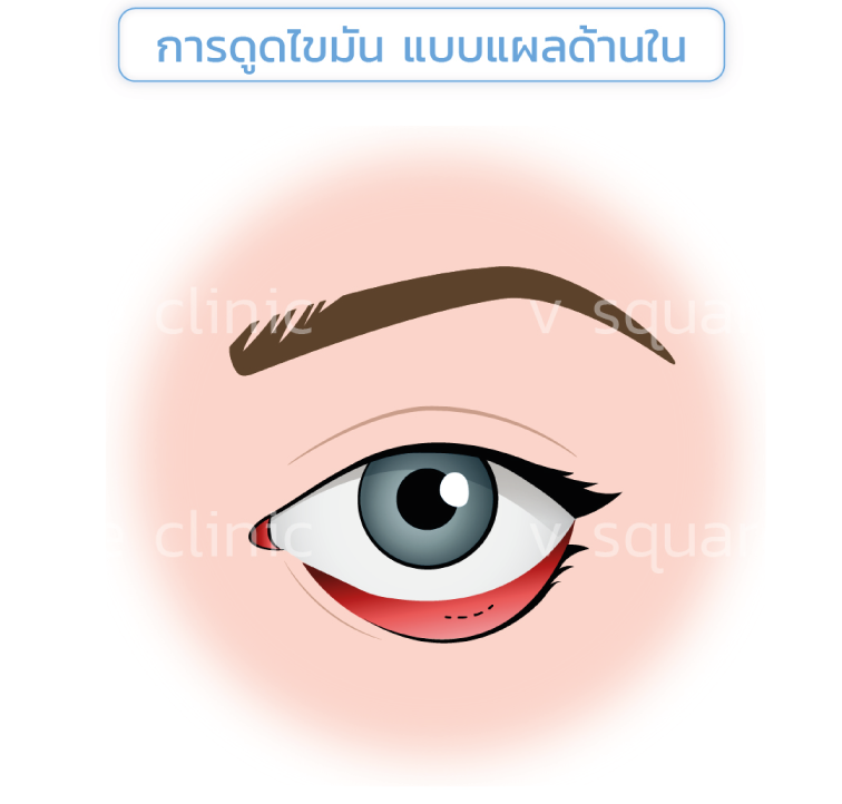 ดูดไขมัน-ลดถุงใต้ตา