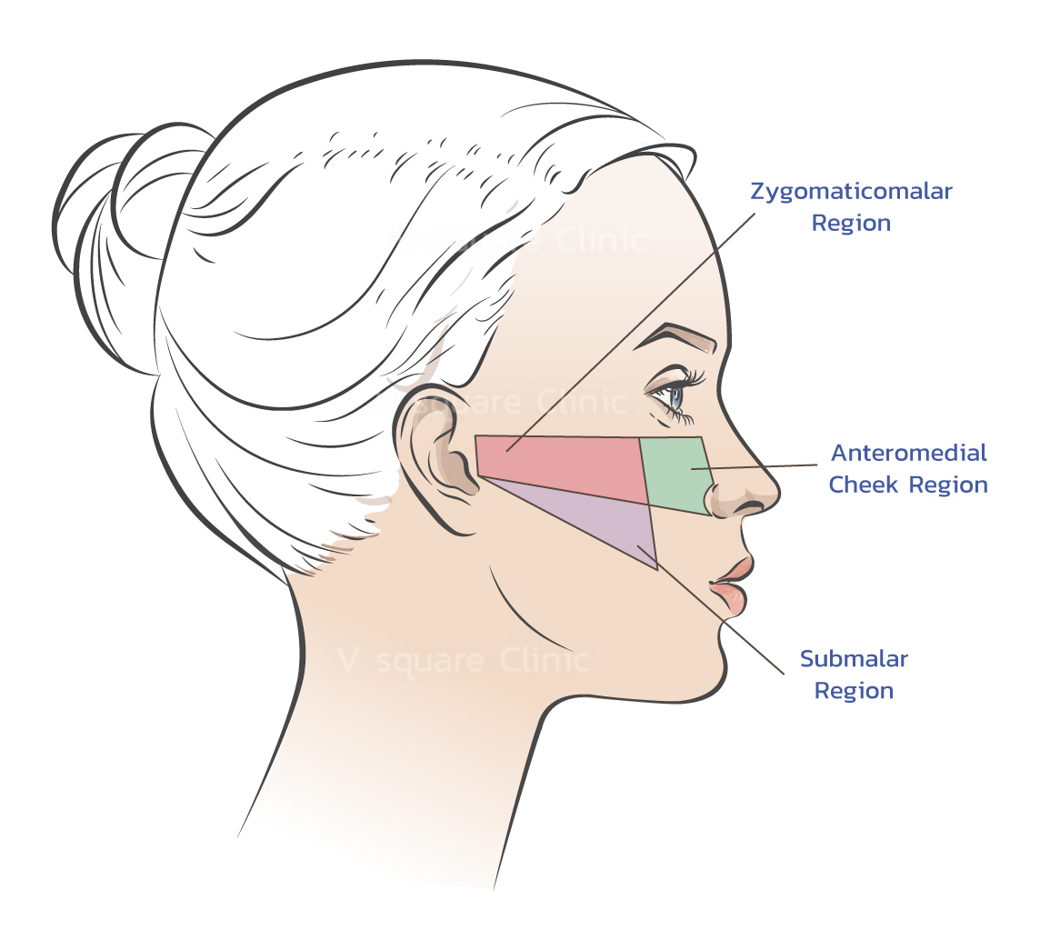 บริเวณ-midface-ที่เติมฟิลเลอร์แก้มส้ม