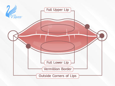 รวมเรื่องน่ารู้-ก่อนตัดสินใจ-“ฉีดฟิลเลอร์ปาก”_370x277