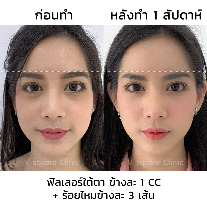 รีวิวฉีดฟิลเลอร์ใต้ตาและร้อยไหม