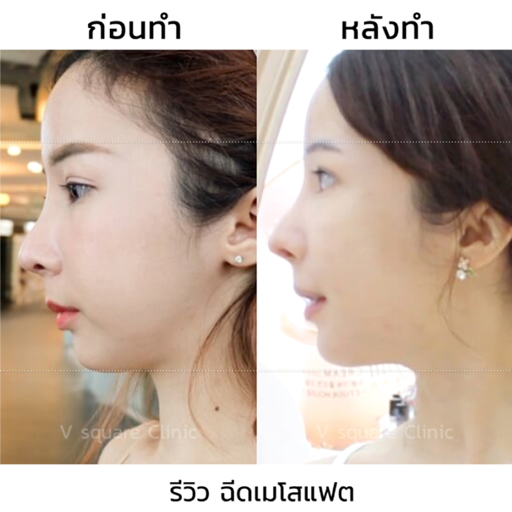 รีวิวฉีดเมโสแฟตเหนียง