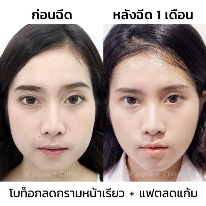 รีวิววิธีทำให้หน้าเรียว