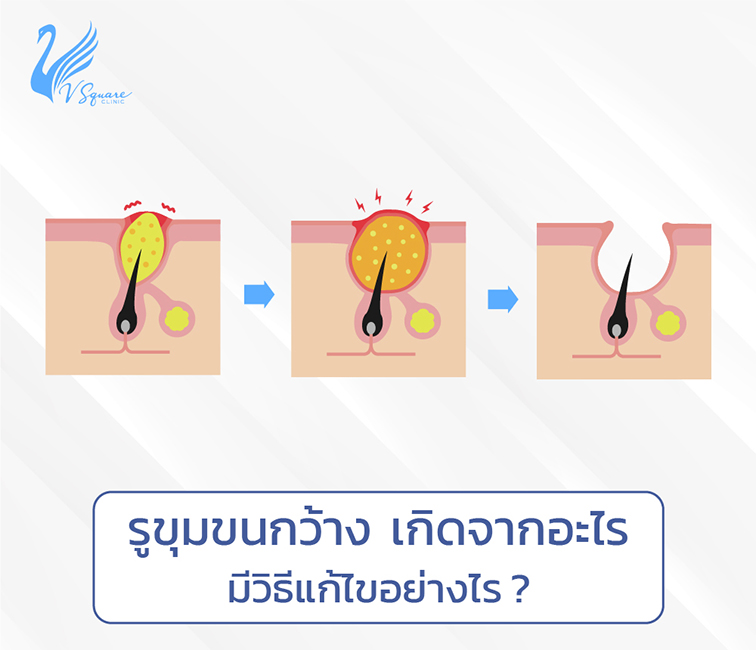 เจาะลึก 5 วิธีรักษารูขุมขนกว้าง ได้ผลจริงไหม เกิดจากอะไร เลือกวิธีไหนดี? เจาะลึก 5 วิธีรักษารูขุมขนกว้าง ได้ผลจริงไหม เกิดจากอะไร เลือกวิธีไหนดี?