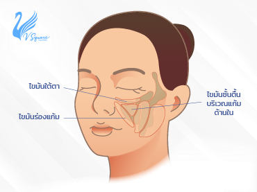 8 เรื่องต้องรู้ แฟตแก้ม คืออะไร ฉีดแล้วลดแก้ม ปรับหน้าเรียวได้จริงไหม? 8 เรื่องต้องรู้ แฟตแก้ม คืออะไร ฉีดแล้วลดแก้ม ปรับหน้าเรียวได้จริงไหม?