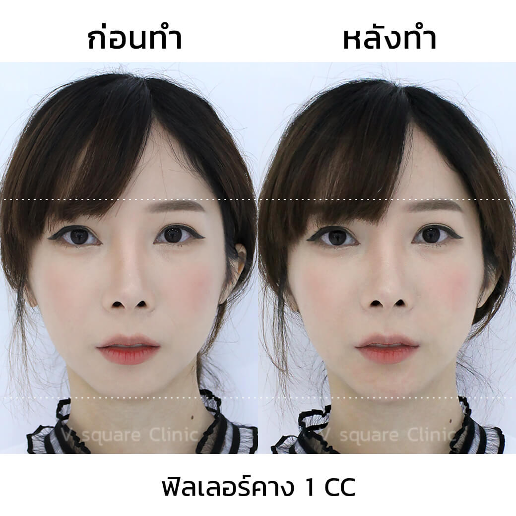 รีวิวฉีดฟิลเลอร์คาง 1 cc ปรับโหงวเฮ้ง