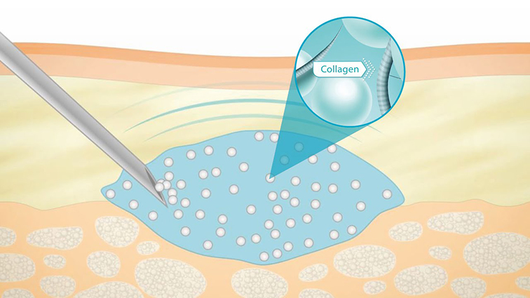 A-Dermal-Filler-Explained