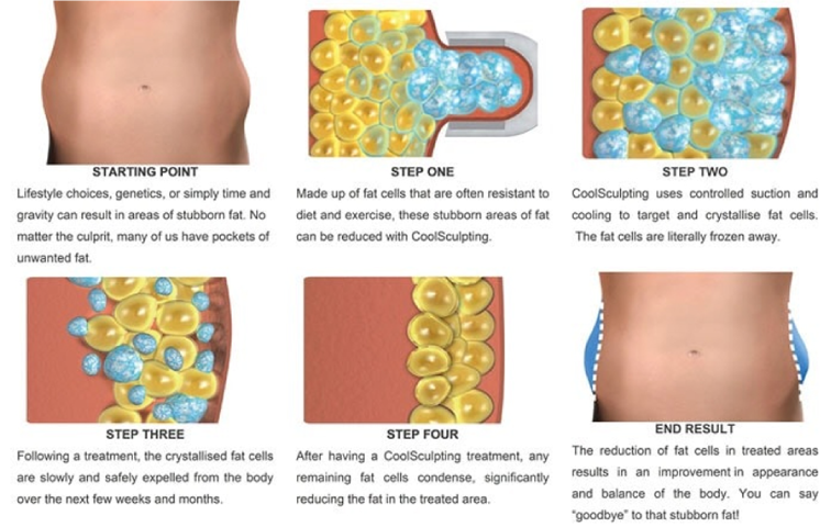 การทำงานของ-CoolSculpting