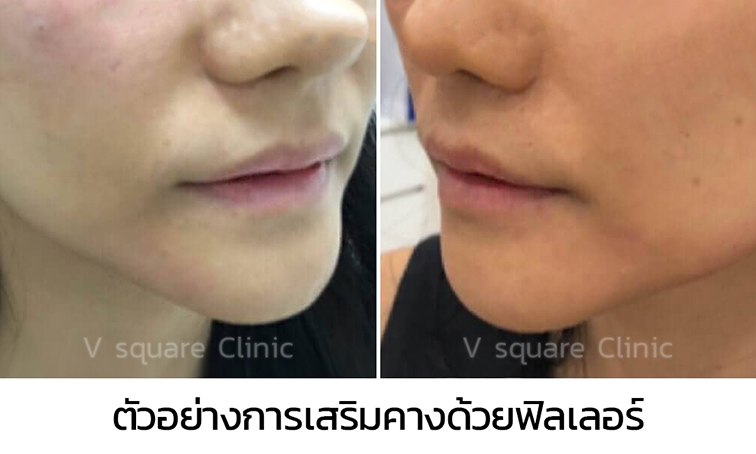 ตัวอย่างการแก้ไขเสริมคางด้วยฟิลเลอร์คาง