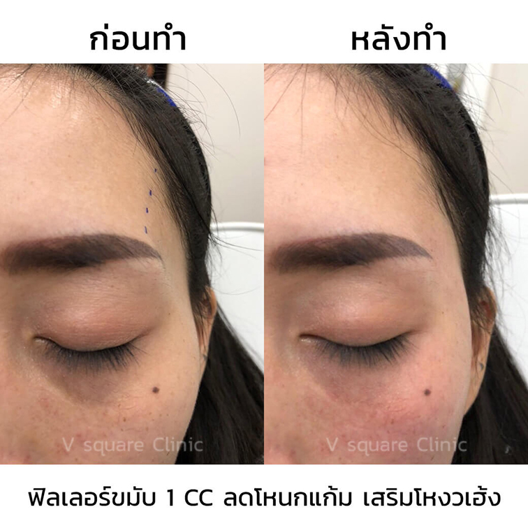 รีวิว-ฉีดฟิลเลอร์ขมับ-1-cc-ลดโหนกแก้ม-เสริมโหงวเฮง