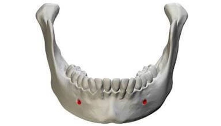 ฟิลเลอร์คาง-mental-foramen