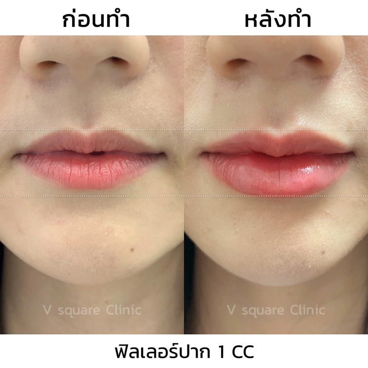 รีวิวฉีดฟิลเลอร์ปากก่อน-หลังทำ