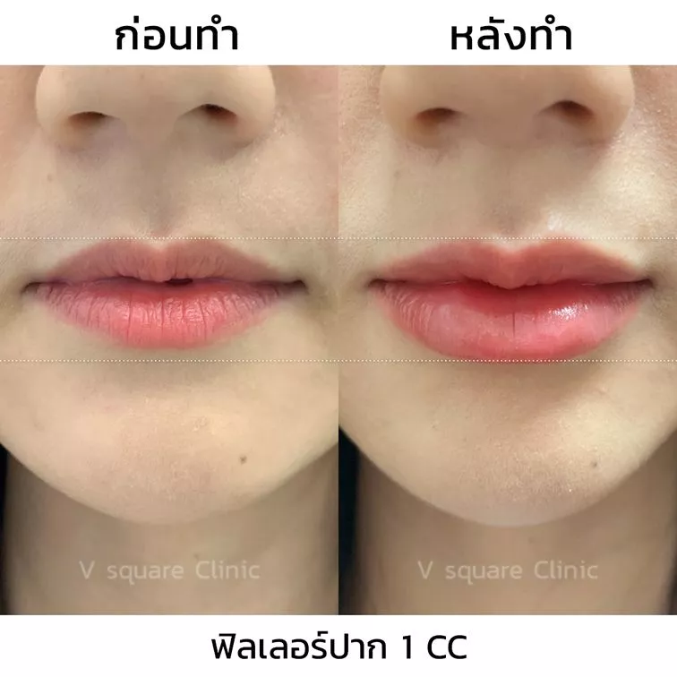 รีวิว ฉีดฟิลเลอร์ปาก ปรับปากบางให้หนาขึ้น อวบอิ่มเป็นทรงสวย. 1 CC