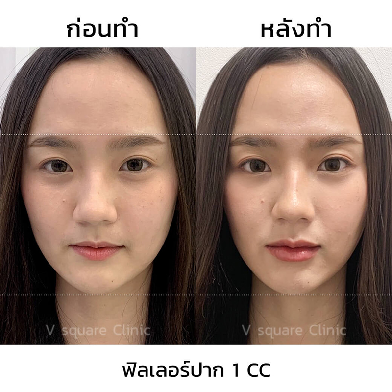 รีวิว ฉีดฟิลเลอร์ปาก ปรับปากบางให้หนาขึ้น อวบอิ่มเป็นทรงสวย