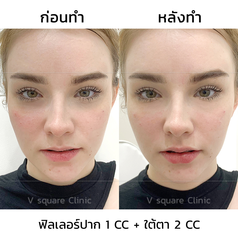 รีวิว ฉีดฟิลเลอร์ปากเพิ่มความชุ่มชื้น